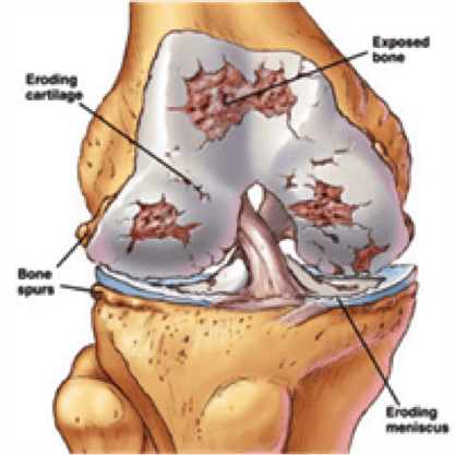 Arthritis in the Knee