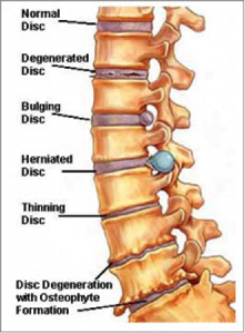 Slipped disc physiotherapy