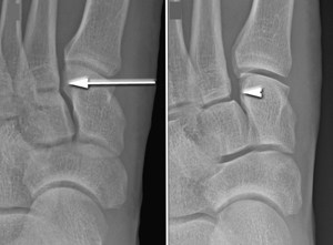 Lisfranc Physiotherapy