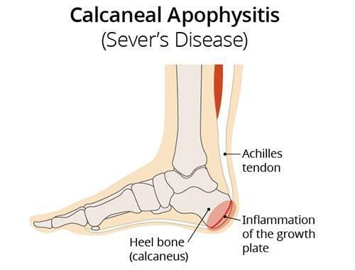 Stress Fracture: Causes, Symptoms & Treatment | The Feet People Podiatry