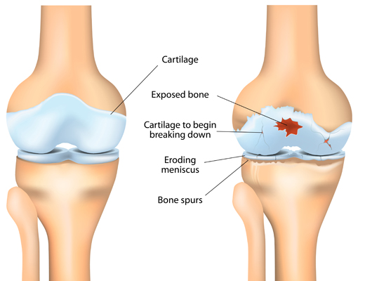 Stiff Knee After Sitting: Causes and Treatments
