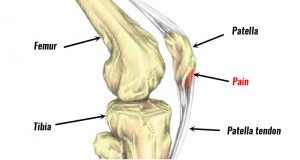 Jumpers knee anatomy