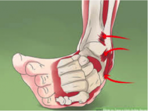 ankle sprain physio