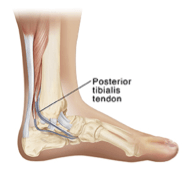 tendon injuries